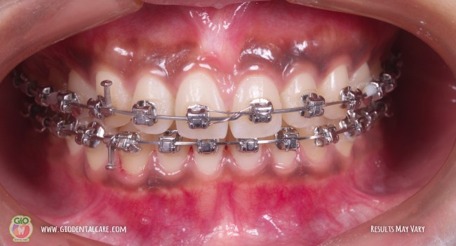 gio-self-ligating-braces